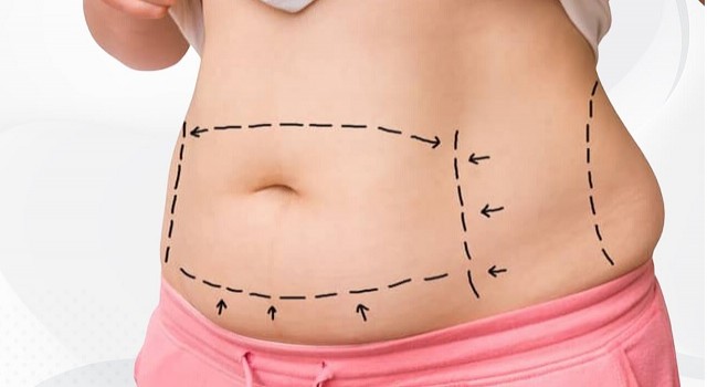 Liposuction kadınlar kadar erkekler tarafından da tercih ediliyor