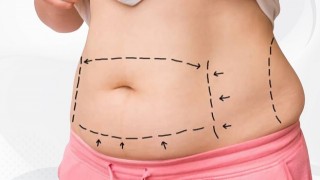 Liposuction kadınlar kadar erkekler tarafından da tercih ediliyor